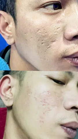 ตัดขอบ #หลุมสิว #รุ่งนภาคลินิก #หมอพลอยหลุมสิว #รู้จากtiktok #co2laser  @Dr. Ploy หมอพลอยหลุมสิว  @Dr. Ploy หมอพลอยหลุมสิว  @Dr. Ploy หมอพลอยหลุมสิว 