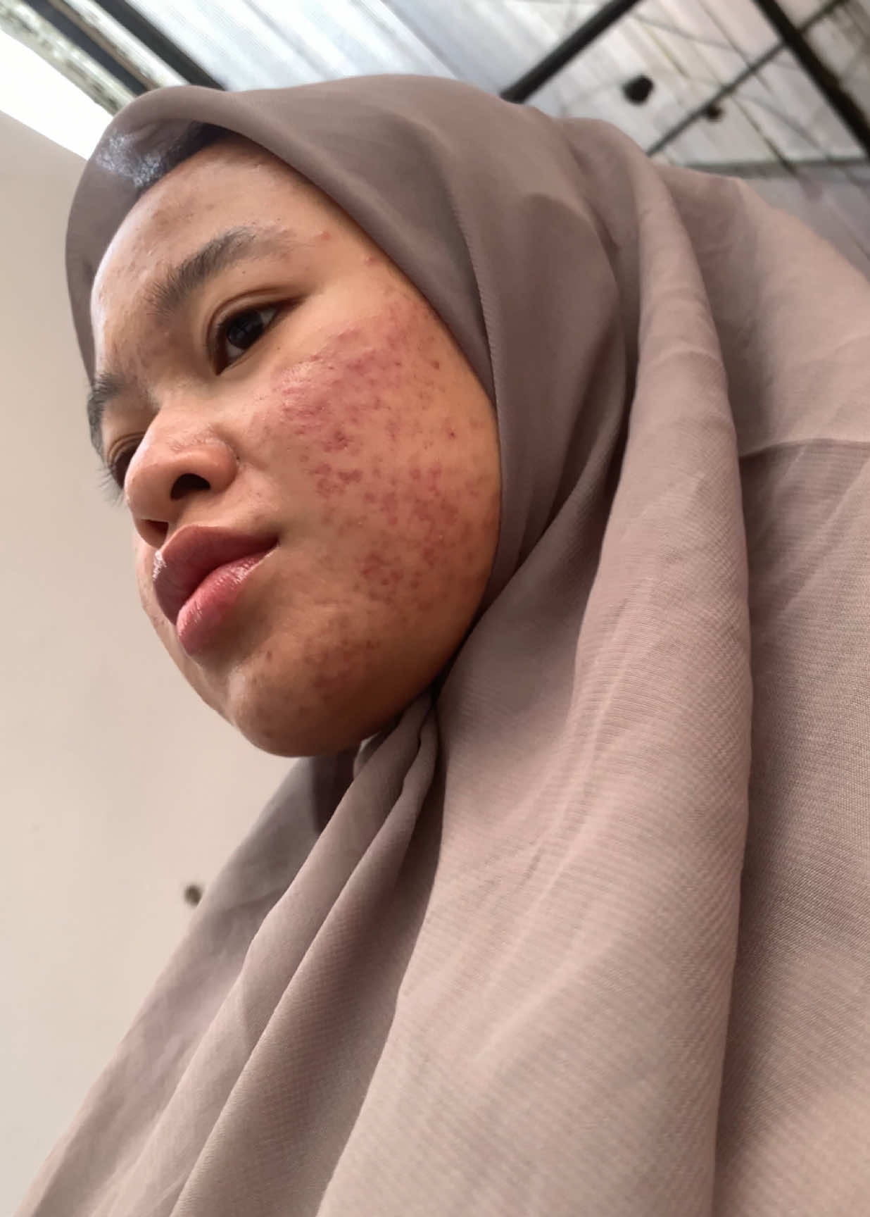 all the patience paid off 🥹💓 #skinjourney #breakout #acnefighter #acnejouney #nanaskinch