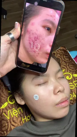 Cập nhật da Mụn#chamsocdaseo#chamsocda#chamsocdamun#chamsocdanam#tanbinh      
