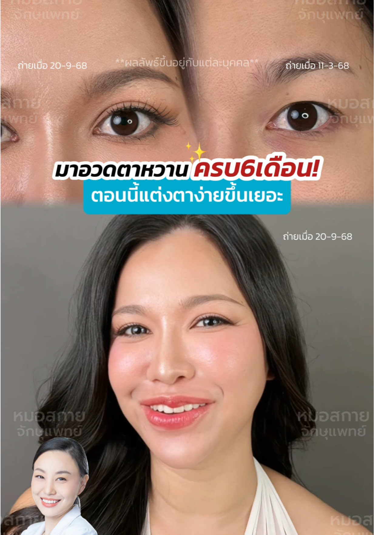 มาอวดตาหวาน ครบ6เดือน✨ ตอนนี้แต่งตาง่ายขึ้นเยอะ  #รีวิวตาสองชั้น #ทำตาที่ไหนดี #sweeteyes #หมอสกาย #skyclinic