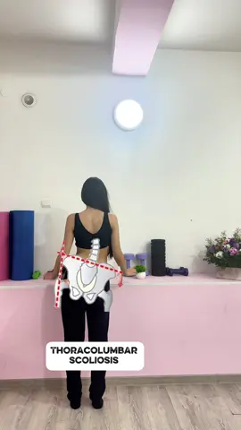 Thoracolumbar scoliosis In thoracolumbar scoliosis, one side appears lower: – the shoulder drops, – the pelvis shifts, – the leg looks shorter. #Scoliosis #ScoliosisTreatment #PostureCorrection #VerginiaCenter #MarinaIspiryan            WhatsApp +37498149914
