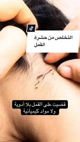 القمل اختفى من أول استعمال… والوصفة سرّ قديم مازال فعّال!#explore #fouryou #وصفات_طبيعية #جمالك_طبيعي #القمل 