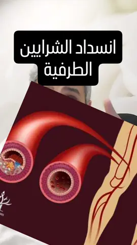 انسداد الشراين الطرفية .. هل ممكن شوية ألم في الساق مع المشي يسبب بتر أو جلطه قلب ومخ؟ 