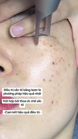 Lazer sắc tố #trendingtiktok #viral #LearnOnTikTok #trendingvideo #lazer 