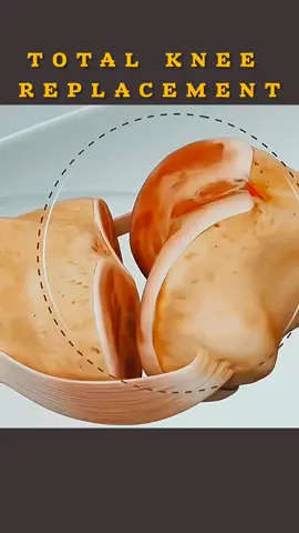 Total knee replacement surgery 3d animation #kneetreatment #kneereplacement #kneesurgery #arthritis #medical3danimation #3dmedicalanimation #animed #surgery