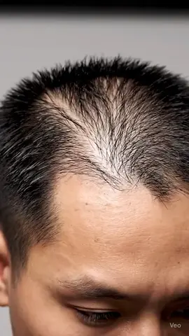 new hair removable spray for hair remove . #foryoupage♥️♥️  #curly  #hair  #trendingclip  #fypシ゚viral🖤tiktok☆♡🦋myvideo❤️❤️🥰🥰🥰 