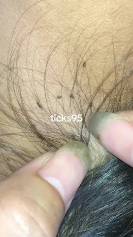 🥶🥶#lice #OhNo #fyp #omg #ticks95 