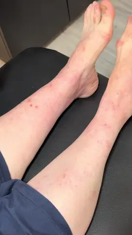 شاهدوا كيف اختفوا الـ Varize بالكامل! النتيجة بتحكي لحالها 😍 لا هيك شغل… لا بلى! 🔥 احجزوا جلساتكن اليوم 📞: 81 339 396 #Shine_Beauty #varizes #confidenceandglow #beforeafter #fyp 