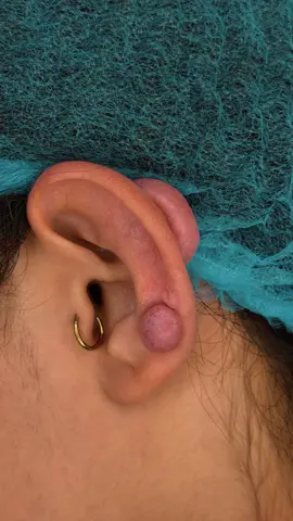 Remoción de Queloides #CapCut #foryou #parati #piercing remoción de cicatriz Queloide por piercing 