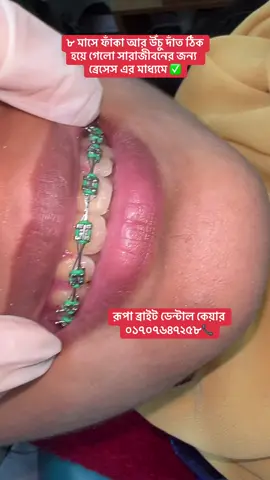 ৮ মাসে ফাঁকা আর উঁচু দাঁত ঠিক হয়ে গেলো সারাজীবনের জন্য ব্রেসেস এর মাধ্যমে ✅#tiktok #foryou #bangladesh🇧🇩 #rupabraightdentalcare #braces 