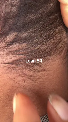 lice removal #omg😱😱 #lice #trending 