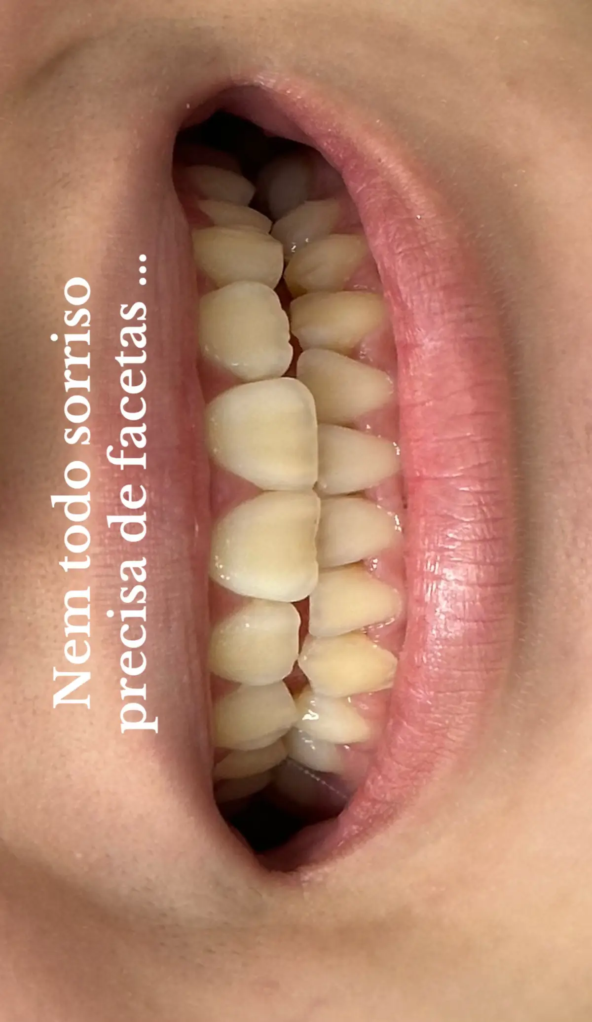 Apenas resina e clareamento 😮‍💨✨ #resina #odontologia #facetasderesina #for #dentista 