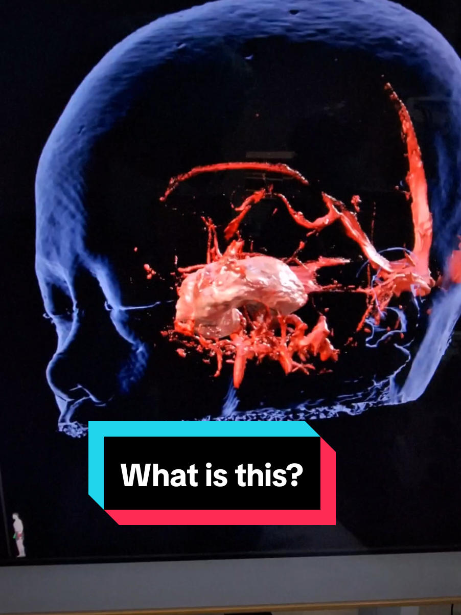 salah satu tumor berjenis meningioma yang mengenai saraf mata #MRI #tumorotak #braintumor #fyp 