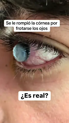 El QUERATOCONO es una enfermedad que ocasiona aumento de MIOPÍA y ASTIGMATISMO. Tiene tratamiento, acércate a un especialista. 