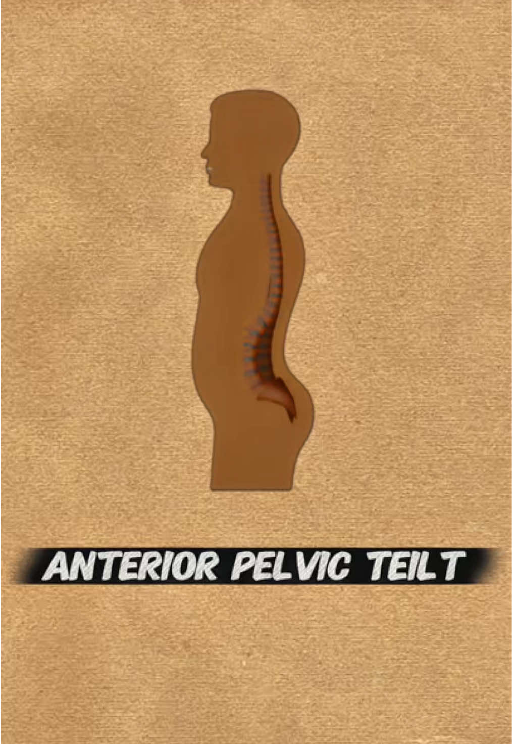 سبب بروز المؤخره وعلاجها-Anterior pelvic teilt- #GymTok #gymrat #gym #جيم #تمارين 