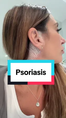 I hate psoriasis… some days it really gets me down but it’s okay to not be okay💕   #psoriasis #selflove #psoriasisjourney #skin #SelfCare 
