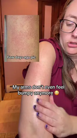 Anyone with KP or strawberry skin should try this! #kp #strawberryskin #keratosispilaris #tiktokshopfalldealsforyou #drmelaxin @Dr.Melaxin Global @Dr Melaxin Official 