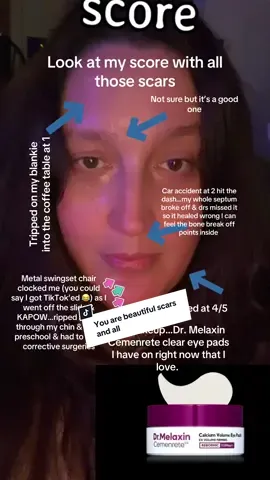 Keep loving yourself…through all the scars and pain YOU are still beautiful…you are magnetic…you are prismatic magic beings of light and love magnifying the beauty of survival…of being a warrior…those are your beauty wounds that you had to love beyond perfection on the level of acceptance that YOU are perfect scars and all…it never has been about being perfect aesthetically, but being perfect in the survival that none of those things broke you…that you can be mended…that we heal and STILL are beautiful and ultimately perfect because being human isn’t perfection it’s messy and it’s hard and it’s imperfectly perfect…when we accept those things about ourselves we become untouchable…so if no one told you today that you matter…you matter…if anyone ever made you feel less than because you had some scar or some other issue or some pain that is their ugliness not you…the greatest gift in our humanity is grace, kindness, love and ultimately acceptance…KNOW me, SEE me, BELIEVE in me…honor me then go be that same humanity into the world. Carry that torch within your soul and being and go spark some hearts! I believe in you! #bballmaven #dankvisionz #inunitywetrust #☠️hauntedsoulz☠️ #thedopestones👑 #duetrandy #tall #tallgirl #kar_modz0404 #mentalhealthmatters #believe #help #alone #scars #selftalk #healing #HealingJourney #trauma #Loveyourboobs 