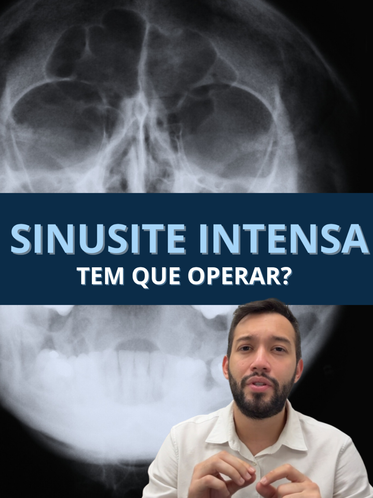 você acha que toda a sinusite intensa precisa ser operada? Nesse vídeo eu te conto! #sinusite #cirurgia #nariz 