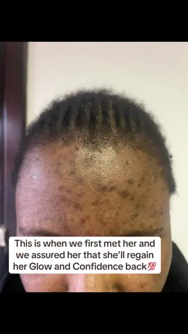 Our job is to help you bring your Glow and Confidence back the safest way🥳🥳🥳 Acne and Dark spots are our speciality 💯 We’re at 📍70 Commissioner street  Kempton Park 1619 Unit 70C ☎️/WhatApp 0604160933 for more info ℹ️, directions 🗺️ and bookings🤗 #foryoupageofficiall #acnetreatment #darkspottreatment #algaepeelkemptonpark #fyp 
