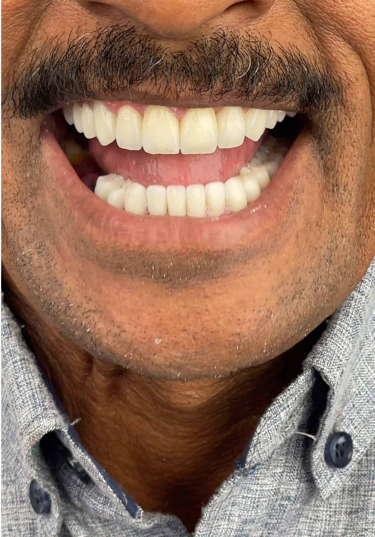 Full mouth rehabilitation in just 10 days 🤍#اسنان #dentist #digitaldentistry #vertiprep 