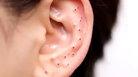 #acne #blackhead #satisfying #pimple #acnetreatment 