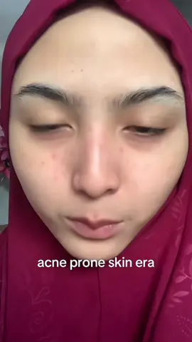 udah cuma pake basic skincare, kenapa masih breakout? @LABORE 