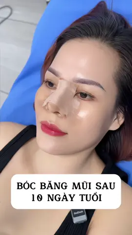 Bóc băng mũi 10 ngày cho Em gái đến từ Bình Dương #bacsitien #chuyensuamui #nangmui #pttm #nangmuicautruc 