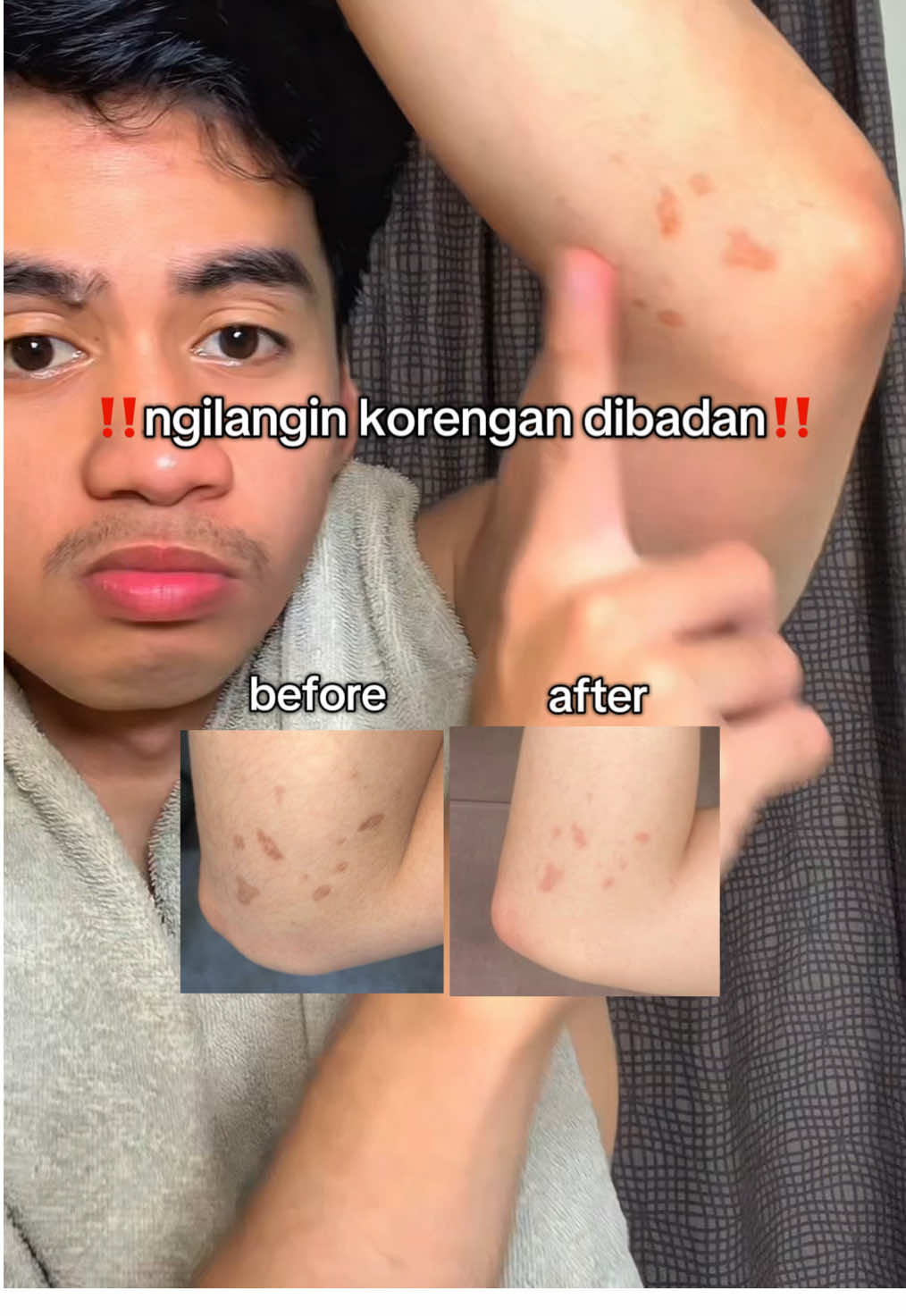 ini real pemakaian 14 hari ygy, cobain aja ciara, tapi hasil tiap orang berbeda #BekasLuka #Ruam #CreamBekasLuka #CreamGatal #CreamIritasi 