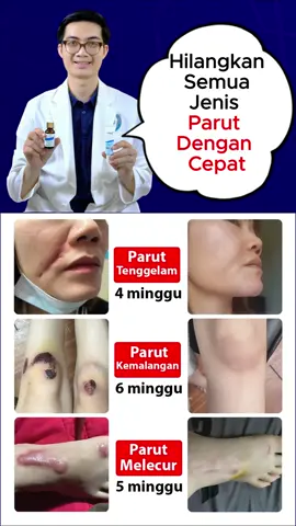 Hilangkan Semua Jenis #parut Dengan Cepat #actiscar #malasyia #trend #hot