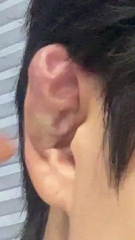 원래 귀로 안돌아오나요? ㅜㅜ #만두귀 #여자만두귀 #cauliflowerear #주짓수 #관리자님추천뜨게해주세요 