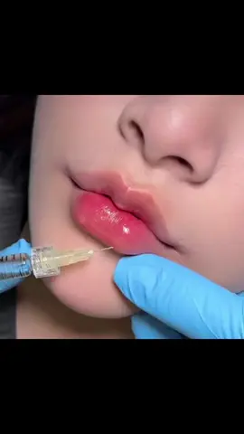 Chúm chím cưng quá 💋👄 #sulefiller #tiemmoi 