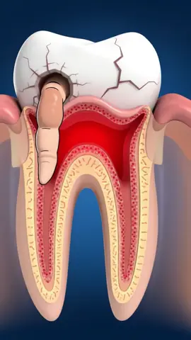 😬 Dolor de muela? Haz esto y desaparece en minutos 🦷🚫 #remediosnaturales #dolordemuela #saludbucal #remedioscaseros #bienestar #cuidadopersonal #salud #parati #fyp #foryoupage 