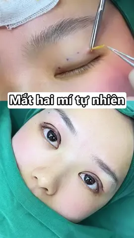 #mímắtdưới #Phẫuthuậtmắthaimí #mắt_2_mí #PTTM #mắt #catmihanni #mimatunhien #mắthaimí 