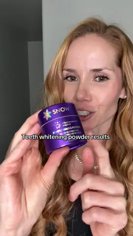 This is just after ONE use. This color correcting purple magic powder teeth whitening booster , really is magic! Super easy to use and gentle on your teeth! Just add the whitening powder to your tooth paste and get an instantly whiter smile #whiteteeth #teethwhitening #whiteningtoothpaste #teethwhiteningtips #tiktokfalldealsforyou 