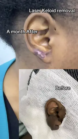 #keloidremoval #keloidexpert #bestdermatologist #knightsskincare254 #keloidtreatment BBS MALL EASTLEIGH LOWER GROUND FLOOR 