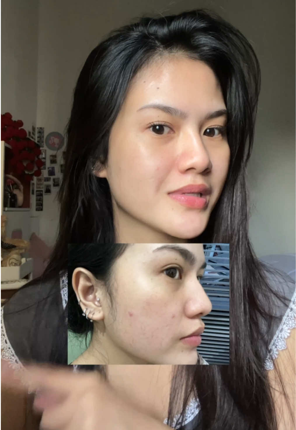 reduce acne & acne marks in 7 days! @Himalaya Indonesia #HimalayaNeemRange #ReduceAcne7Days 