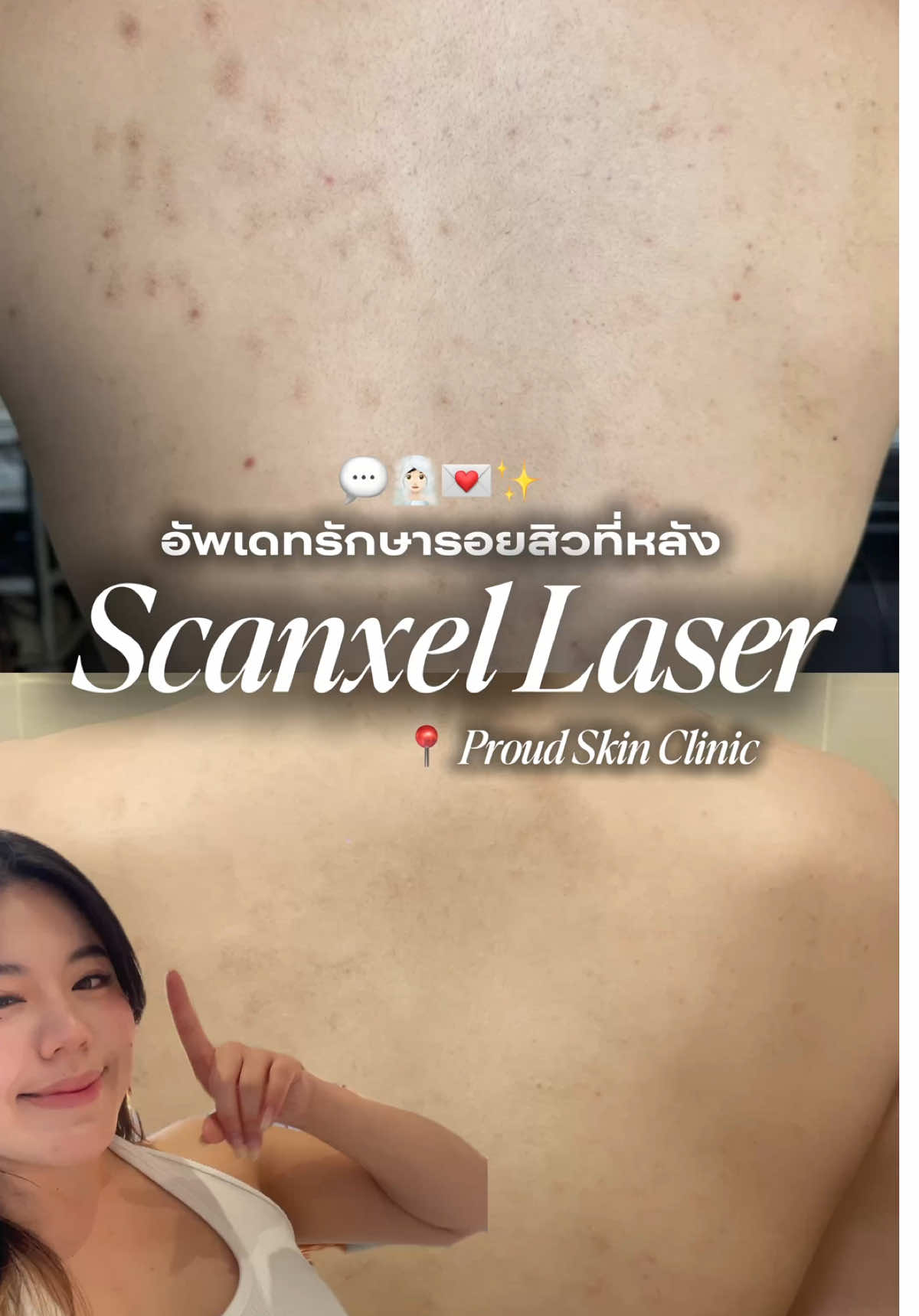 อัพเดทหลังทำโปรแกรมรักษารอยสิว Scanxel Laser ที่  📍@proudskin.clinic  💕 ผลลัพท์ปังมากก ! #scanxellaser #เลเซอร์รอยสิว #รักษารอยสิว #สิวที่หลัง #เลเซอร์รอยแผลเป็น 