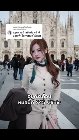 ตอบกลับ @NamployPchrp ค่อยๆยุบลงเรื่อยๆแล้วค่ะ☺️ขอบคุณสำหรับกำลังใจดีๆ นะคะ ปอล์ตัดสินใจถูกมากค่ะที่รีบแก้ อันเดิมทำมานาน9ปี จนมันเริ่มปลายบาง แก้มาแล้วชอบมากเลย ถ่ายรูปมุมไหนก็สวย😍🥰 #s45clinic #หมอบิ๊กs45clinic #เสริมจมูก #โอปอล์ @S45 Clinic @หมอบิ๊ก S45 Clinic 