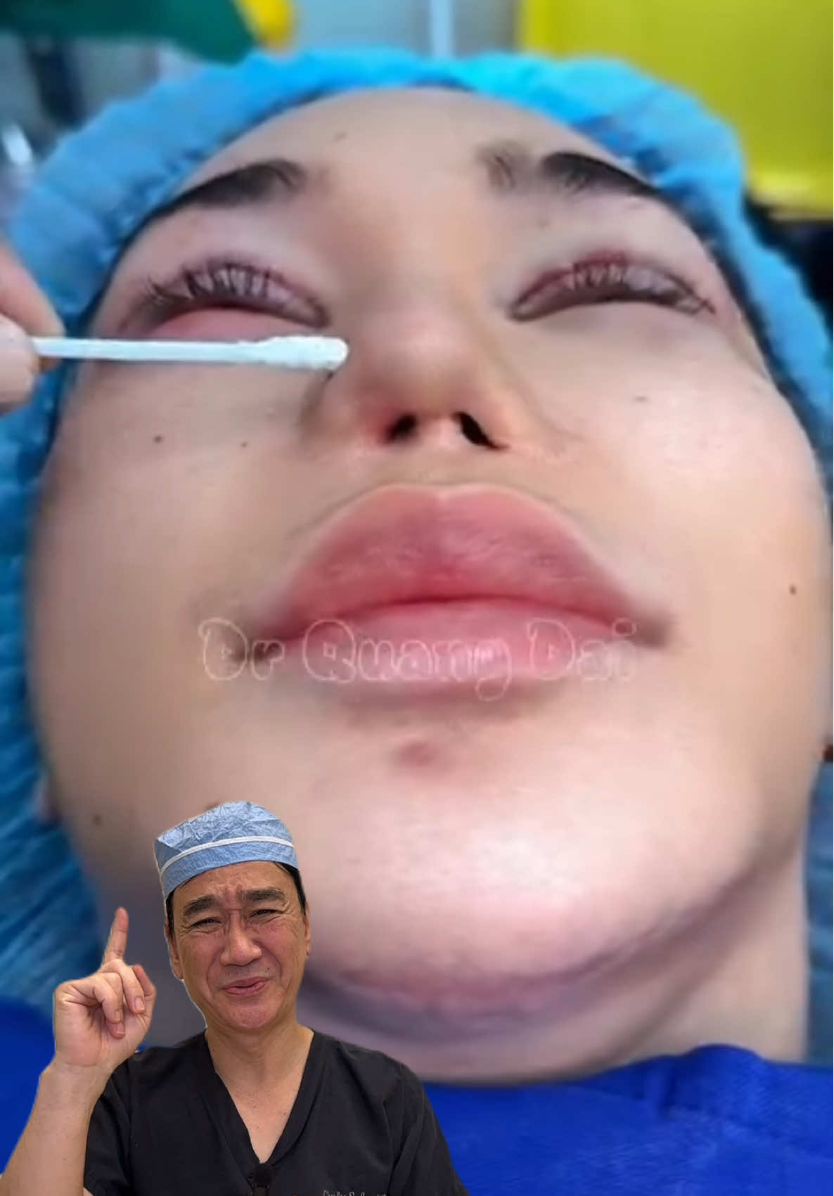 This patient (not my patient) has a scar contracture of the nostrils. This is frequently the result of an infection or a complicated nose surgery. This would require a multi step operation to fix, usually with a lot of grafts typically from the ear. This is such an unfortunate situation and I hope for the best for her! 