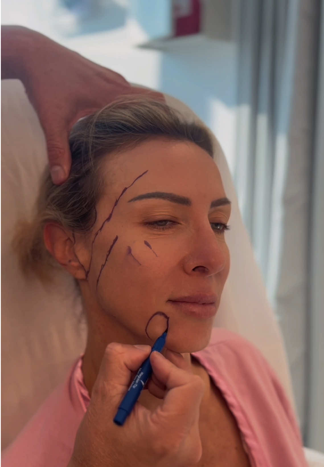 🖊️ Facelift markings = the blueprint. Before every KalosLift extended deep plane facelift, Dr. Stong marks the key landmarks of the face and neck: the mini incision around the ear, the cheek entry point for the deep plane, the jawline, platysmal bands, pre-jowl sulcus, and the voice box. These markings are the same for everyone, but they serve a critical purpose — helping protect the facial nerves and guiding Dr. Stong to deliver safe, natural transformations ✨ 📍 Kalos Facial Plastic Surgery | Atlanta, GA 📞 (404) 963-6665 🔗 kalos-plasticsurgery.com #ksthetics  #btcplasticsurgeon  #kaloslift #deepplanefacelift #atlantafacelift