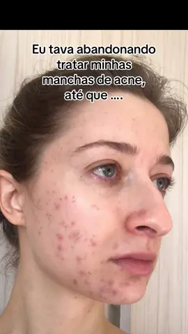 Livre de manchas minha autoestima é outra 🥹😍🫶🏻.   Tá no carrinho 🧡 laranja, é só clicar e mudar sua pele também, amiga!   #vitaclare #tiktokshopbrasil #autoestima #acne #pelesaudavel 