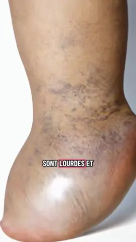 Lien produit : https://curcleans.com/products/chaussettes-de-compression-larges #pourtoii #fatigue #jambeslourdes 