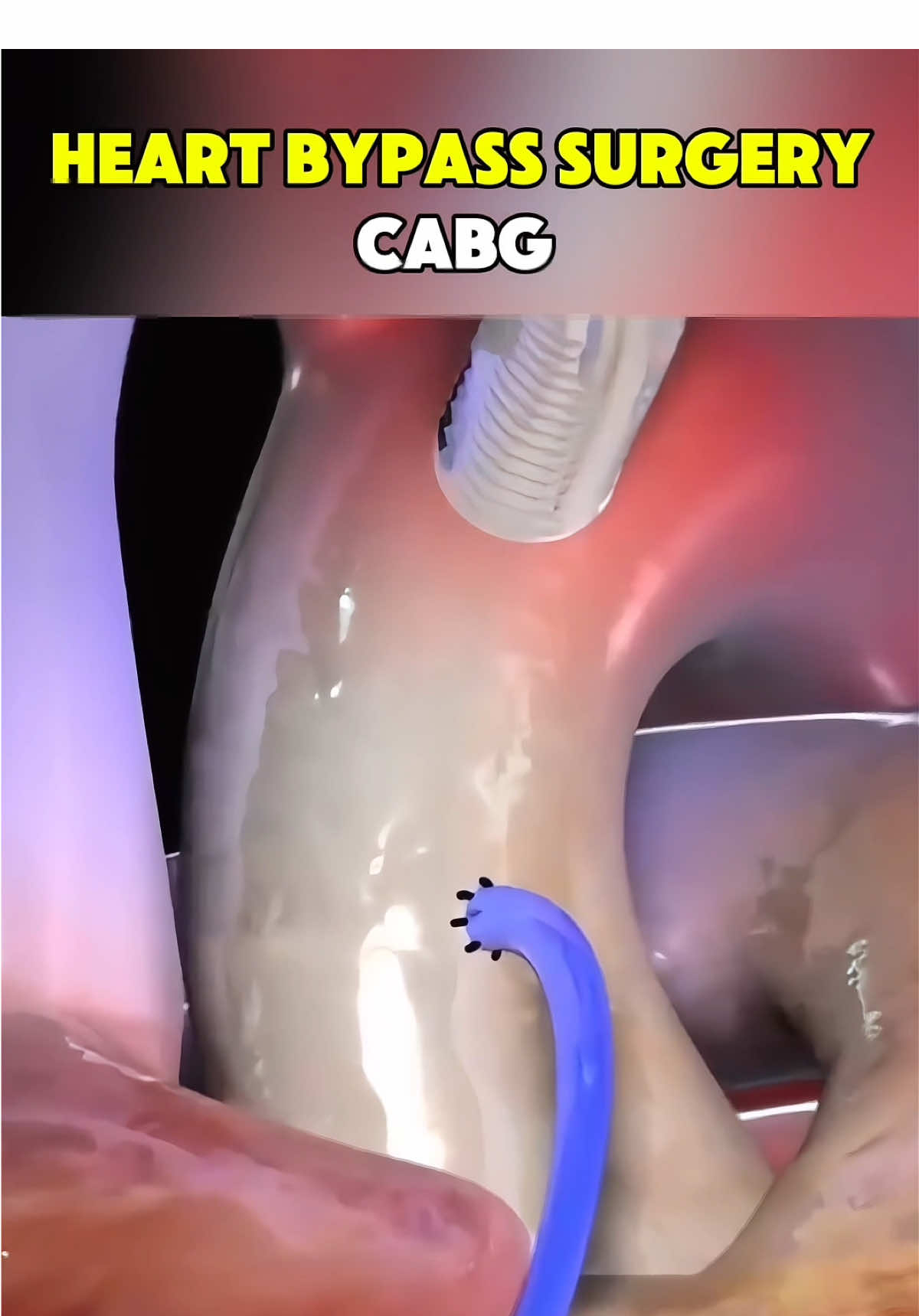 Ever wondered how heart bypass surgery is performed? #CABG #HeartBypass #HeartSurgery #CardiacSurgery #CoronaryArteryBypass          