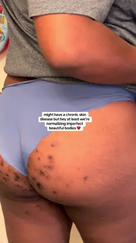 Perfection is my enemy 🫶🏾 #Hidradenitissuppurativa #HSConnect #hsawareness #FindUs25 #socialcydd 