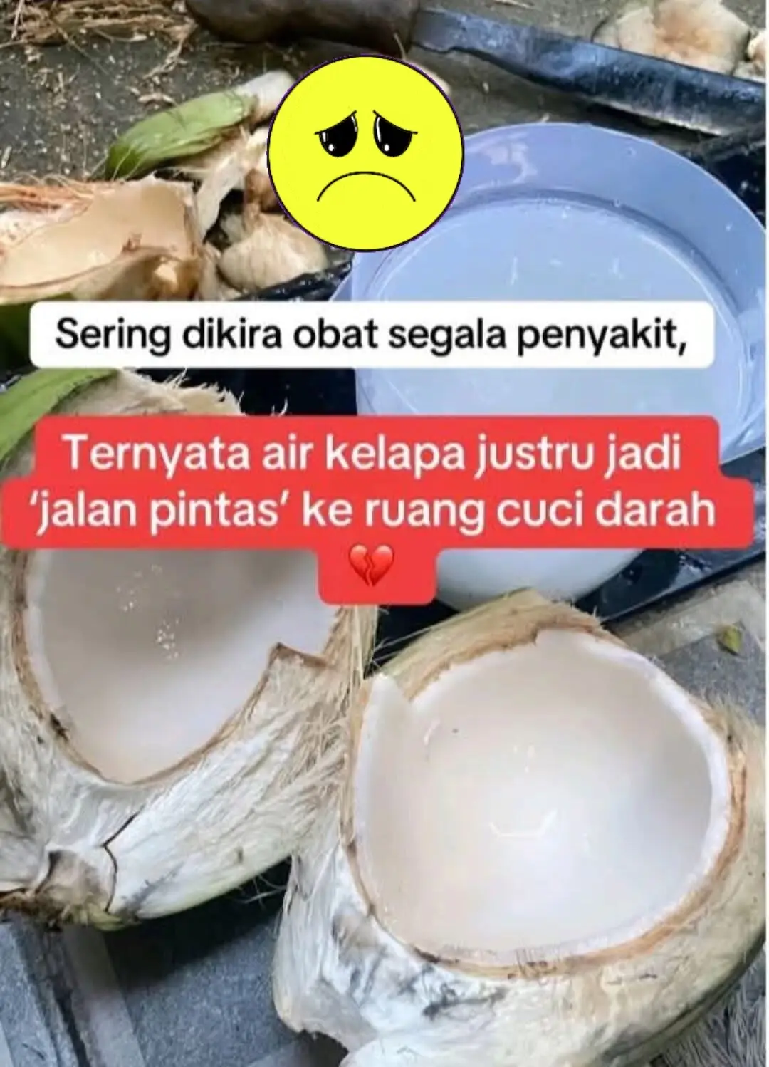 PENTING‼️ Banyak orang ngasih air kelapa ke pasien sakit dgn harapan cepat pulih. PadahaL buat penderita gagal ginjal, ini bisa jadi bom waktu 🥶❗️ KENAPA air kelapa bisa berbahaya buat penderita gagal ginjal? KARENA kandungan kalium (potassium) dan elektrolitnya tinggi. Pada ginjal sehat, kalium berlebih bisa dikeluarkan lewat urin. Tapi kalau ginjal udah lemah, kalium akan menumpuk di darah → inilah yang disebut hiperkalemia. ✍🏽🫢 📌 POIN ALASAN bahayanya :  1. KALIUM TINGGI – 1 gelas (240 ml) air kelapa bisa mengandung 600 mg kalium. Padahal penderita gagal ginjal HARUS SANGAT  MEMBATASI asupan KALIUM harian. ✍🏽 2. GINJAL RUSAK tidak bisa membuang kalium – akibatnya kalium menumpuk di darah (hiperkalemia).✍🏽 3. KADAR CAIRAN BERLEBIH → Pasien ginjal biasanya dibatasi minum. Air kelapa termasuk cairan tinggi elektrolit, BISA MEMICU penumpukan cairan → bengkak di kaki, sesak napas, bahkan edema paru. ✍🏽 4. EFEK PADA GULA DARAH → Air kelapa mengandung glukosa alami. Buat penderita ginjal dengan diabetes, ini BISA MEMPERBURUK KONTROL GULA DARAH → mempercepat kerusakan ginjal. ✍🏽 5. INTERAKSI DENGAN  OBAT→ Banyak pasien gagal ginjal konsumsi obat penurun tekanan darah (misalnya ACE inhibitor) yang sudah meningkatkan kadar kalium. Ditambah air kelapa = risiko hiperkalemia makin tinggi. JANGAN SAMPAI peduli kita JADI BAHAYA buat keluarga, teman, dan orang terkasih kita yg kena gagal ginjal. ##KONSULTASIKANdulu dgn dokter.✍🏽🥰 #semogabermanfaat😇🙏  #sharejikabermanfaat ✍🏽🥰🙏