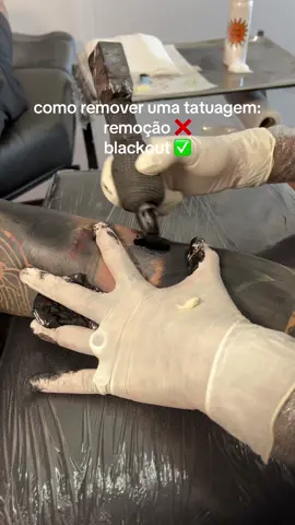 como remover uma tatuagem: