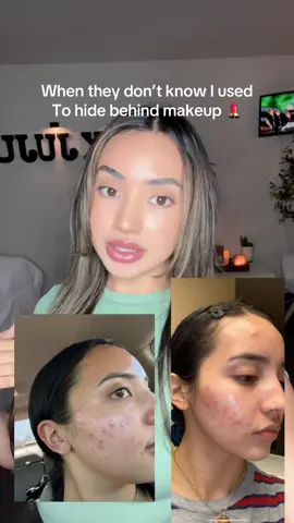 😩🥺  #skincareproducts #skincaretiktok #acne #acneproneskin 