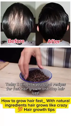 How to grow hair fast_ With natural ingredients hair grows like crazy_ 💯 Hair growth tips#skincare #wrinkles #Recipe #beauty #fyp 