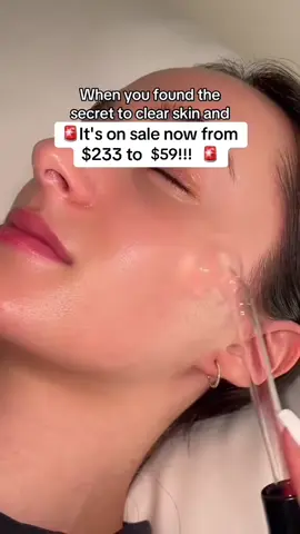 #acne #highfrequencywand 